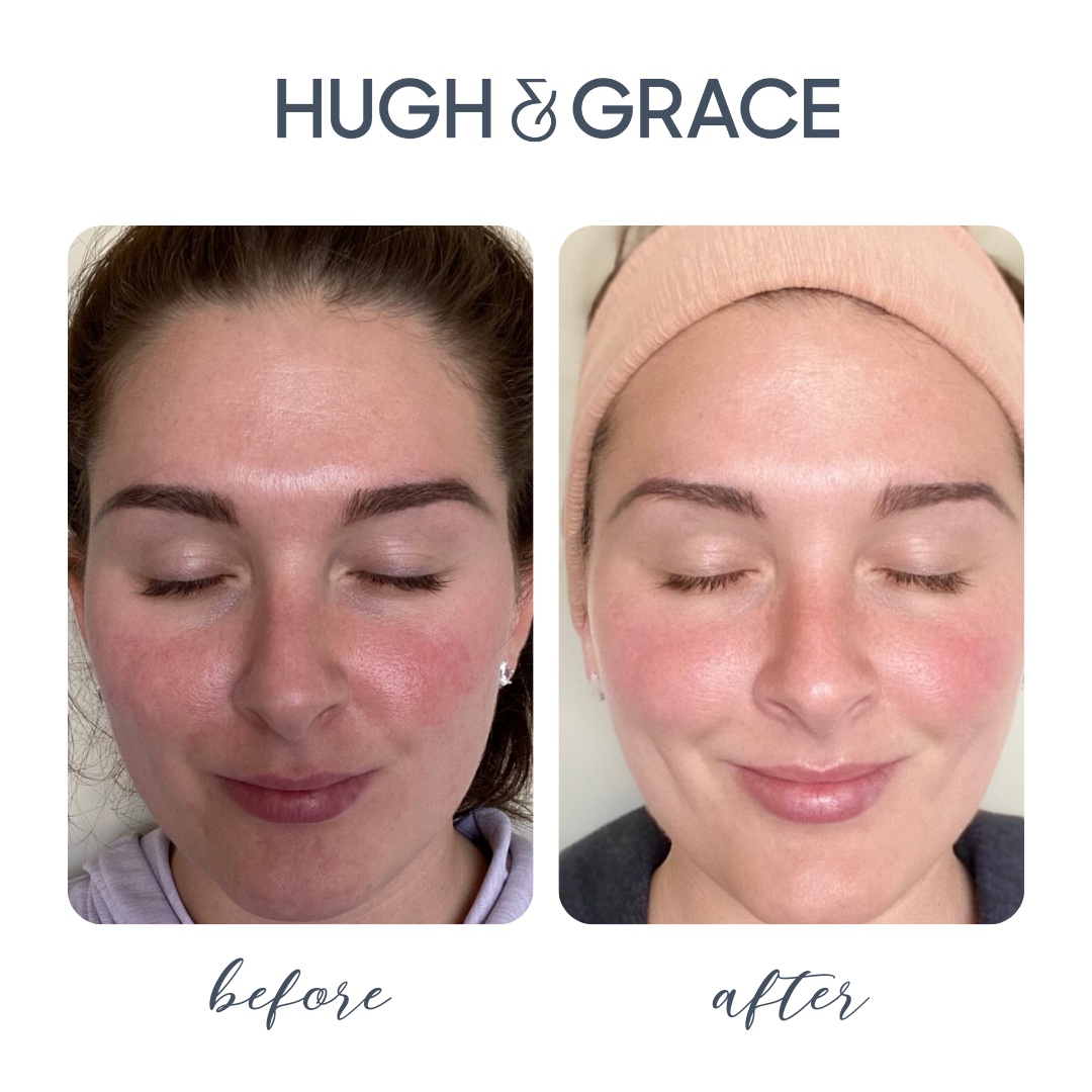 Someone else's before and after skin transformation with Hugh and Grace Face Serums